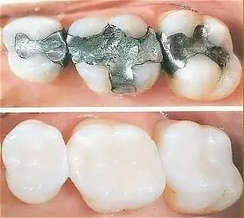 Tooth-Colored-Fillings-jpg